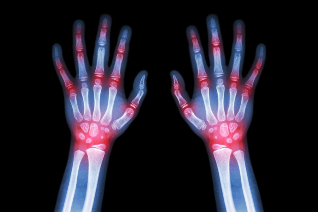 Rheumatoid arthritis , Gout arthritis