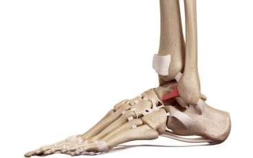 IBJI Doctor Talks Ankle Sprains and Instability