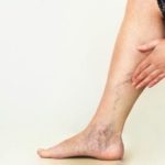Are Your Throbbing Legs Deep Vein Thrombosis (DVT)?