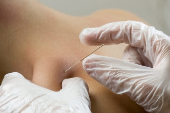 Benefits of Dry Needling for Pain Relief