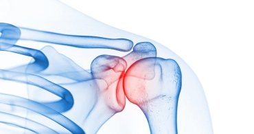 Osteoarthritis vs. Rheumatoid Arthritis