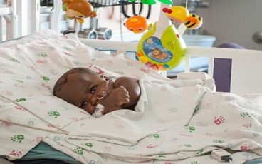 Baby Born with Four Legs and Two Spines is Thriving After Complex Surgery: Dominique's Story