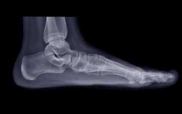 Subtalar Joint Fusion Surgery Eliminates Ankle Pain for Longtime Nurse