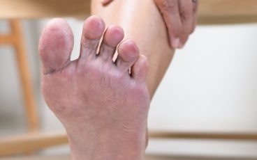One Man's Journey from a Broken Foot to Treatment for Charcot Foot Syndrome