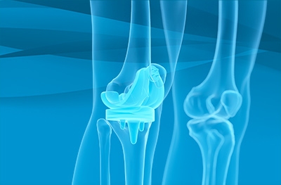 Minimally Invasive Knee Replacement