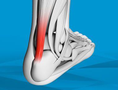 Achilles Tendon Repair Surgery