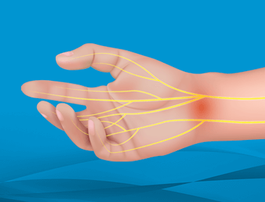 Carpal Tunnel Syndrome