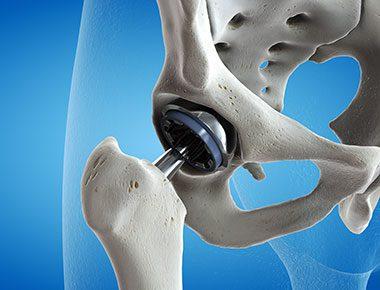 Total Hip Replacement