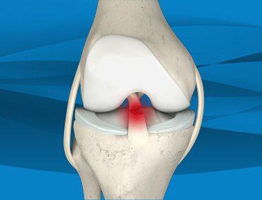 Meniscus Tears