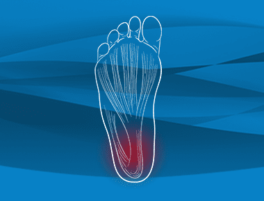 Plantar Fasciitis