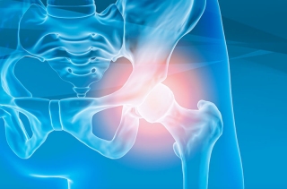 Anterior Hip Replacement