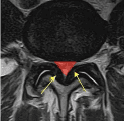 A bunched up ligament can cause pain for patients