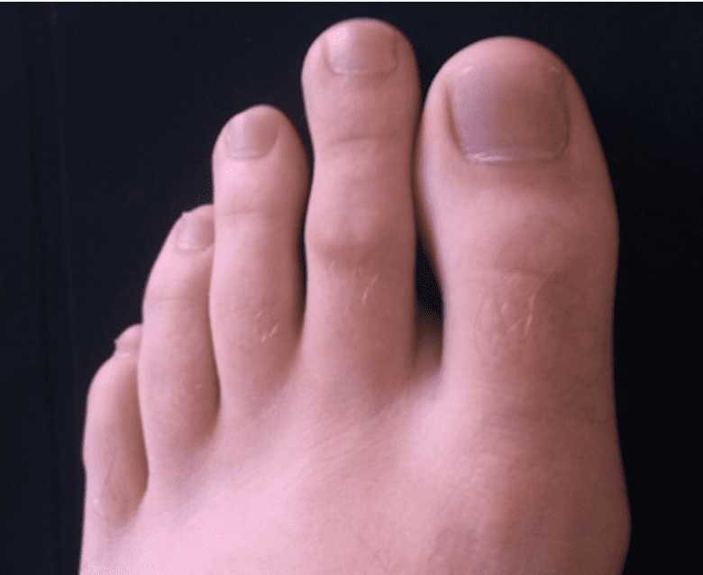 Mortons' type foot structure