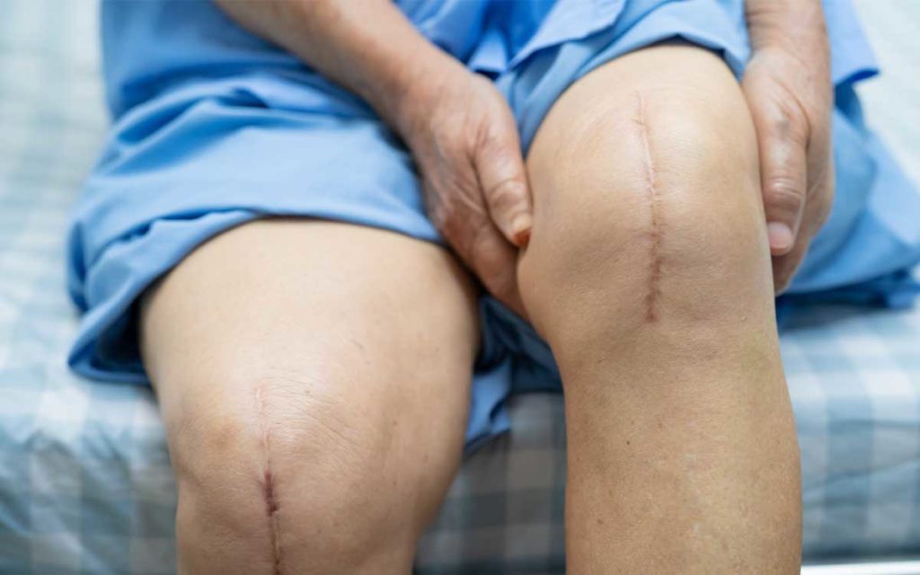 woman with healed knees after knee replacement surgery