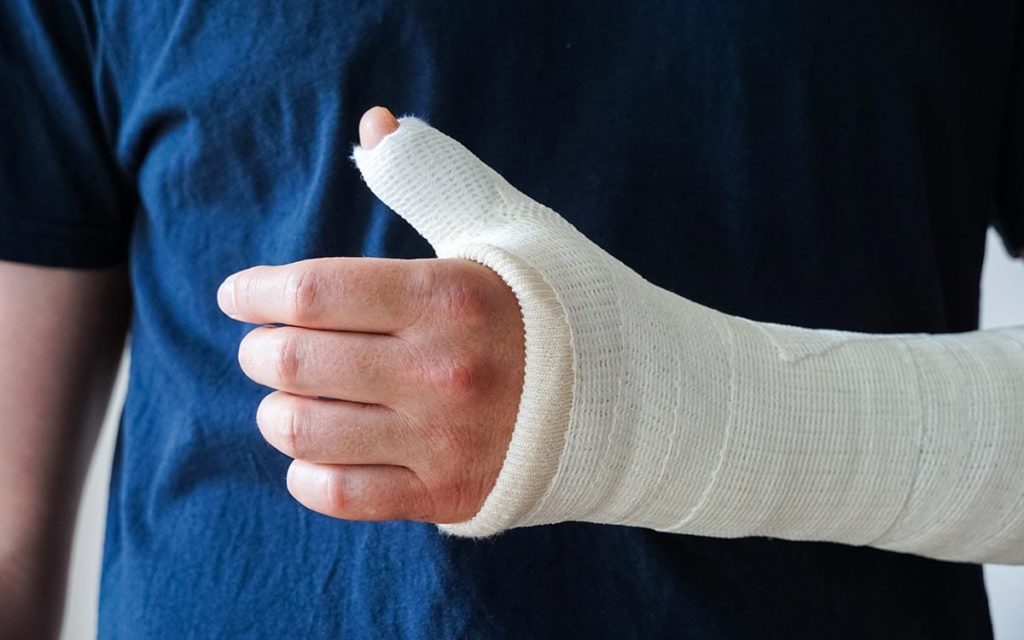 Casted hand after thumb surgery