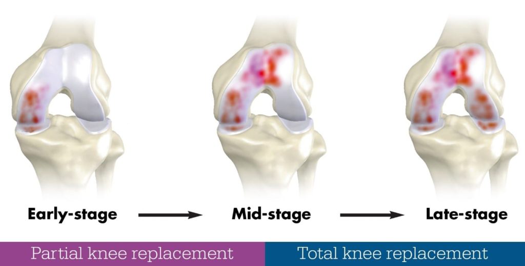 partial knee replacement cmpared to total knee replacement