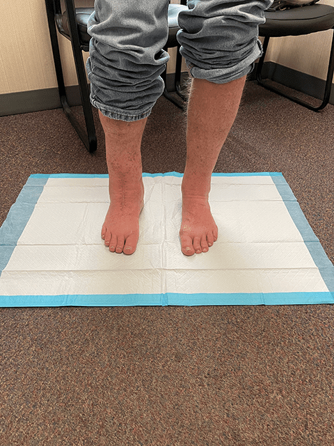 This follow-up visit photo shows how Dave's heels are symmetrical, flat, and straight, thanks to 3D ankle reconstruction surgery. 