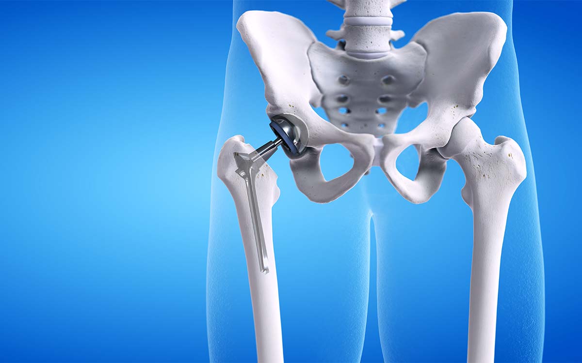 Pros and Cons of Hip Replacement Surgery | IBJI